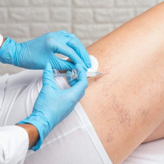 A close up on a nurse's hands as she removes varicose veins on upper thigh with a syringe and medical adhesive.