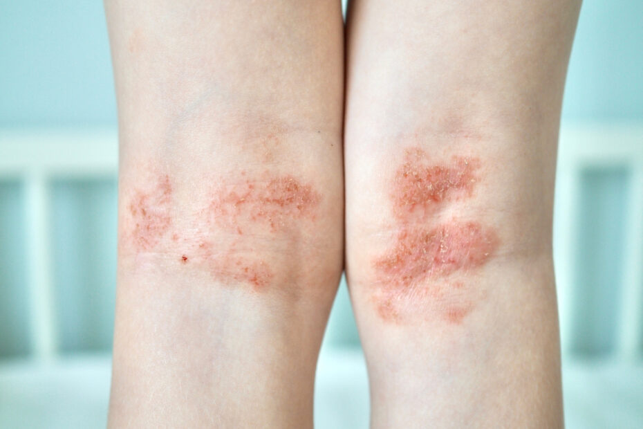 Scaly,Skin,Behind,Knees,Varicose,Vein,Venous,Eczema,Causes,Itchy,Skin.