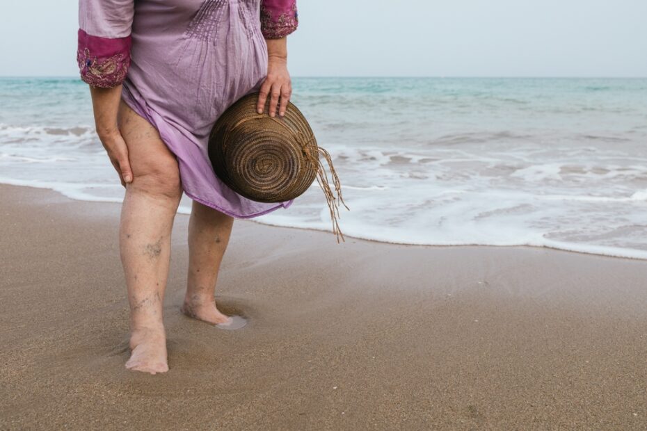 Woman,On,Beach,Holds,Dress,Up,Showing,Clusters,Of,Varicose,Veins,And,Spider,Veins.