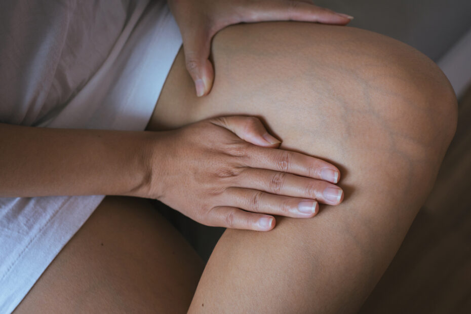 Woman,Checks,Veins,,On,Leg,After,Flying,Deep,Vein,Thrombosis,(DVT),Maybe,The,Cause,Or,Superficial,Venous,Thrombosis,(SVT)