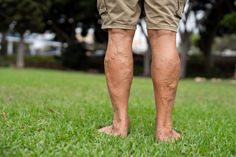 Man,Standing,Legs,Have,Prominent,Varicose,Veins,Cost,Of,Varicose,Vein,Treatment,In,New,Zealand,Varies,By,Provider.