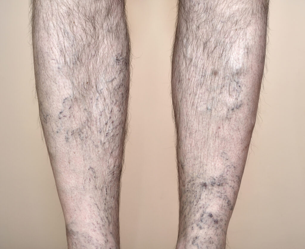 Varicose,Veins,In,Men,Backs,Of,Man's,Legs,With,Visible,Veins.