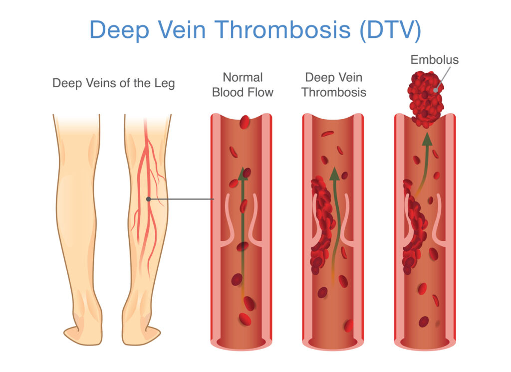 Illustration,Of,Deep,Vein,Thrombosis,In,The,Deep,Veins,Of,Legs,Discuss,Deep,Vein,Thrombosis,Vs,Varicose,Veins.