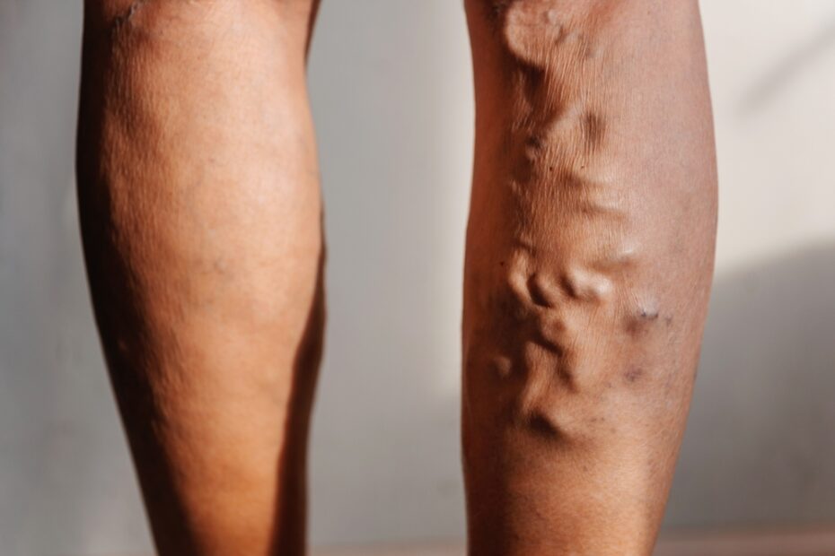 Woman's,Right,Legs,Extensive,Varicose,Veins,Old,Varicose,Veins,Can,Still,Be,Treated.